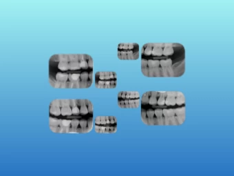 Radiografia Interproximal Digital