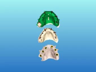Cirurgia Guiada para Implantes Dentários