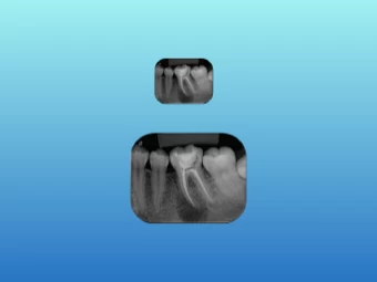 Radiografia Periapical Digital