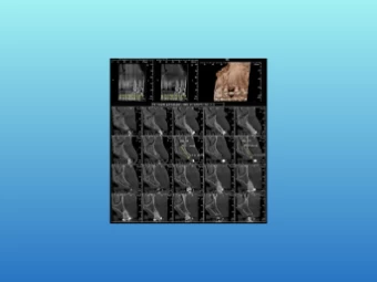 Tomografia Computadorizada por Feixe Cônico