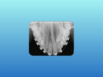 Radiografia Oclusal Digital