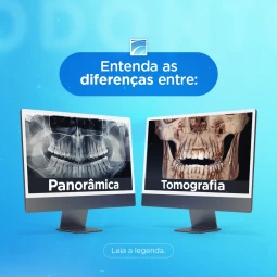 As diferenças entre Rx Panorâmico e Tomografia
