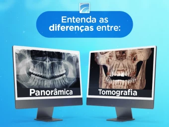 As diferenças entre Rx Panorâmico e Tomografia